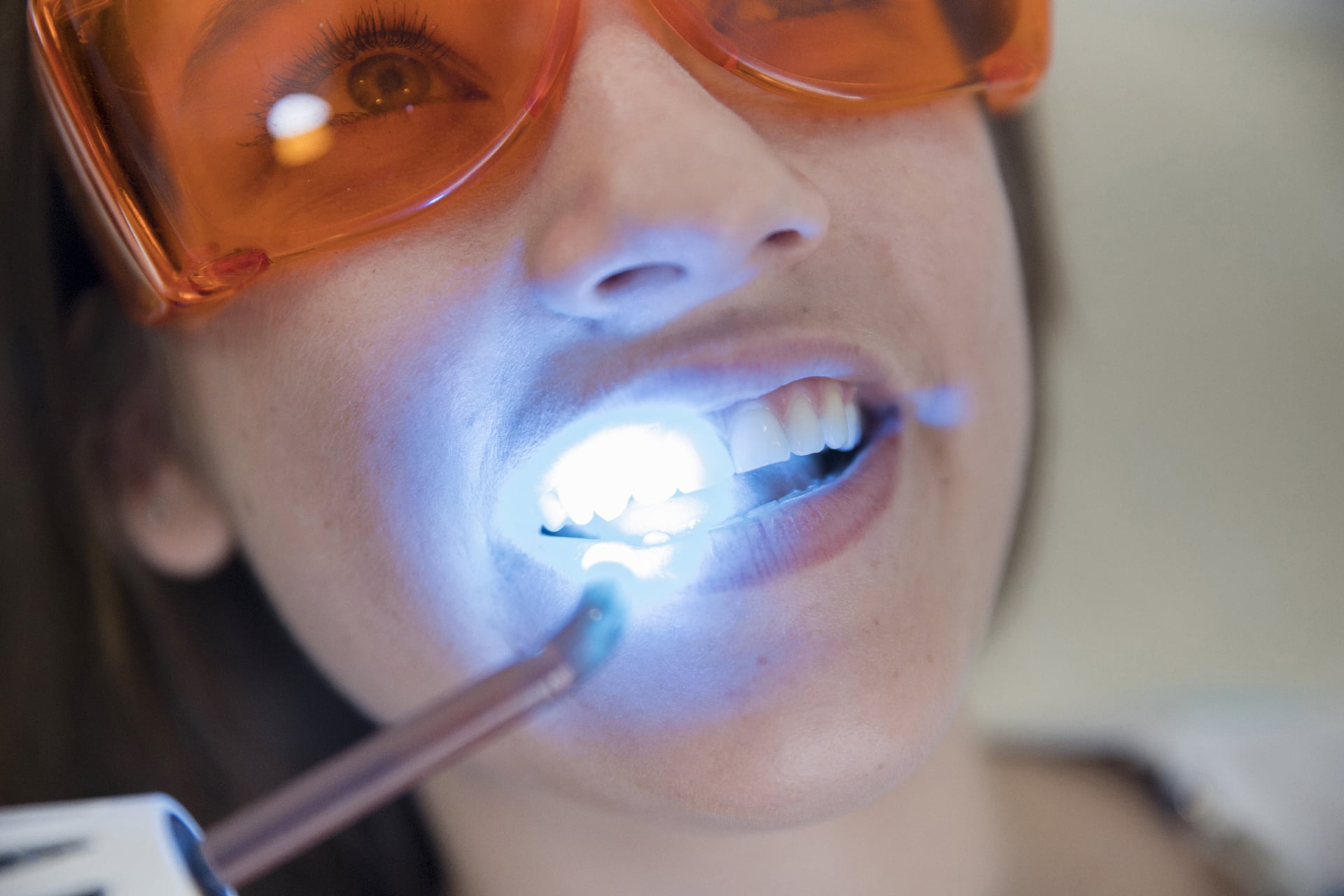 TeethWhitening Dangers As A Client and Beautician